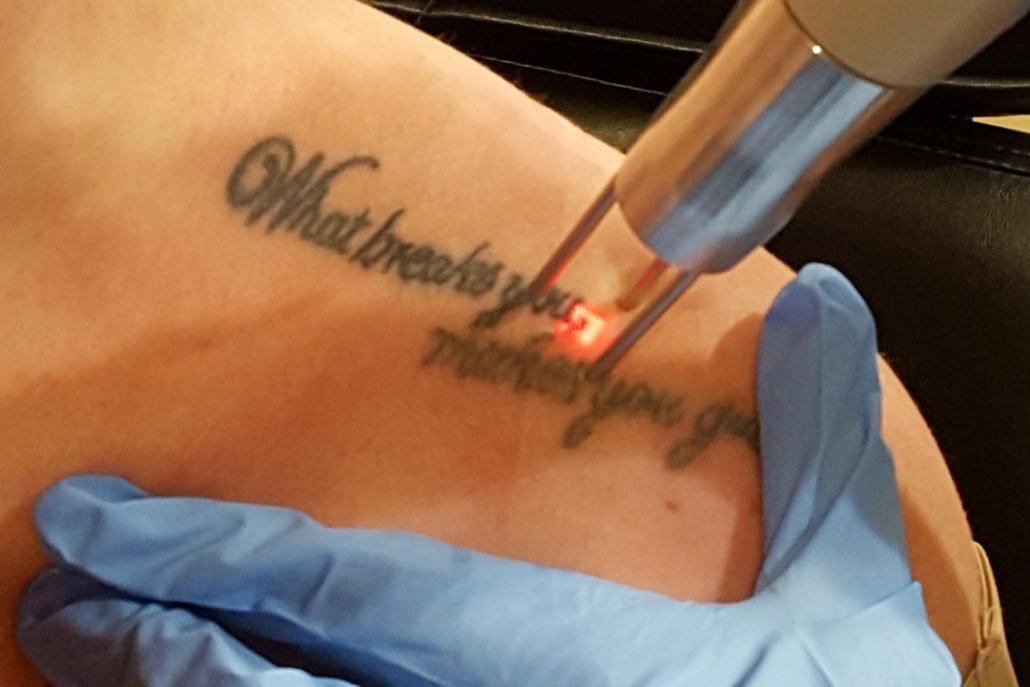 laser tattoo removal services